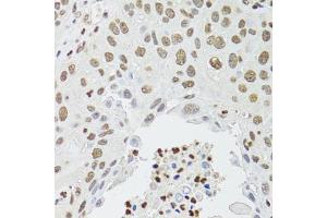 Immunohistochemistry of paraffin-embedded human lung cancer using CDX2 antibody (ABIN1871774) at dilution of 1:100 (40x lens). (CDX2 anticorps)