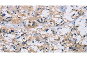 Immunohistochemistry of paraffin-embedded Human thyroid cancer using IL17RB Polyclonal Antibody at dilution of 1:40 (IL17 Receptor B anticorps)