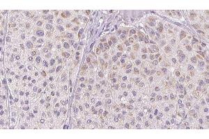 ABIN6277763 at 1/100 staining Human melanoma tissue by IHC-P. (CCL2 anticorps  (Internal Region))