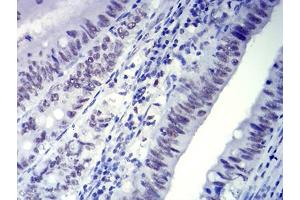 Immunohistochemical analysis of paraffin-embedded rectum cancer tissues using CTNNBL1 mouse mAb with DAB staining.