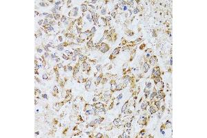 Immunohistochemistry of paraffin-embedded human lung cancer using AIFM3 antibody (ABIN5996156) at dilution of 1/100 (40x lens). (AIFM3 anticorps)