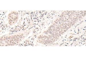 Immunohistochemistry of paraffin-embedded Human esophagus cancer tissue using ZBED1 Polyclonal Antibody at dilution of 1:40(x200)