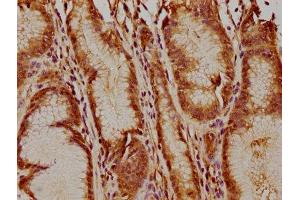 IHC image of ABIN7174271 diluted at 1:400 and staining in paraffin-embedded human gastric cancer performed on a Leica BondTM system. (USP17L5 anticorps  (AA 19-235))