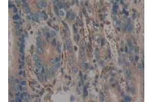 Detection of CALU in Human Stomach cancer Tissue using Polyclonal Antibody to Calumenin (CALU)