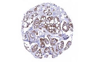 Breast Adenoid cystic breast cancer with strong membranous mesothelin immunostaining in a subset of cells
