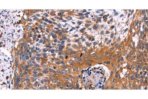 Immunohistochemistry of paraffin-embedded Human cervical cancer using RDX Polyclonal Antibody at dilution of 1:60 (Radixin anticorps)