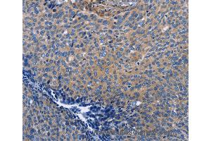 Immunohistochemistry of Human cervical cancer using INTS10 Polyclonal Antibody at dilution of 1:50 (INTS10 anticorps)