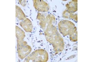 Immunohistochemistry of paraffin-embedded human gastric cancer using IGF2BP3 antibody (ABIN5971465) at dilution of 1/100 (40x lens). (IGF2BP3 anticorps)