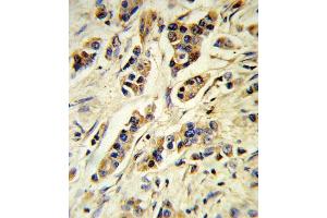 Formalin-fixed and paraffin-embedded human breast carcinoma reacted with IL10 Antibody (Center), which was peroxidase-conjugated to the secondary antibody, followed by DAB staining. (IL-10 anticorps  (AA 27-53))