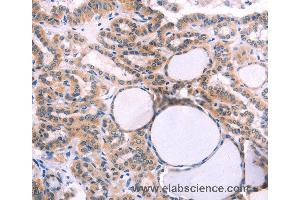 Immunohistochemistry of Human thyroid cancer using IL1RL1 Polyclonal Antibody at dilution of 1:40 (IL1RL1 anticorps)