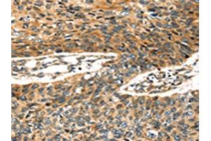 The image on the left is immunohistochemistry of paraffin-embedded Human esophagus cancer tissue using ABIN7128026(STX19 Antibody) at dilution 1/35, on the right is treated with fusion protein. (Syntaxin 19 anticorps)