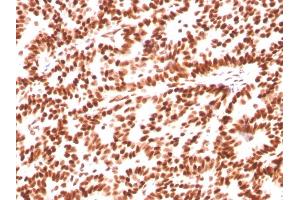 Formalin-fixed, paraffin-embedded human Breast Carcinoma stained with Estrogen Receptor alpha Mouse Monoclonal Antibody (ESR1/3559).