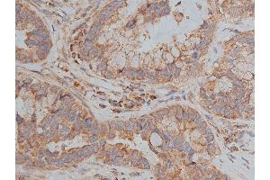 ABIN6268647 at 1/200 staining human lung cancer tissue sections by IHC-P.