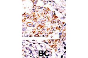 Formalin-fixed and paraffin-embedded human cancer tissue reacted with NME3 polyclonal antibody  , which was peroxidase-conjugated to the secondary antibody, followed by DAB staining. (NME3 anticorps  (Internal Region))