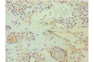 Immunohistochemistry of paraffin-embedded human breast cancer using ABIN7172529 at dilution of 1:100 (E2F6 anticorps  (AA 1-281))