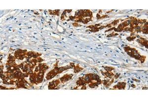 Immunohistochemistry of paraffin-embedded Human colon cancer using ADCY3 Polyclonal Antibody at dilution of 1:50 (ADCY3 anticorps)