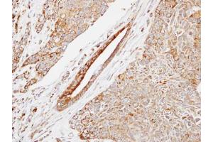 IHC-P Image Immunohistochemical analysis of paraffin-embedded human lung SCC, using HSP22, antibody at 1:500 dilution.