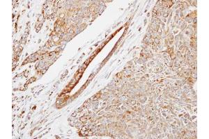 IHC-P Image Immunohistochemical analysis of paraffin-embedded human lung SCC, using HSP22, antibody at 1:500 dilution. (HSPB8 anticorps  (C-Term))