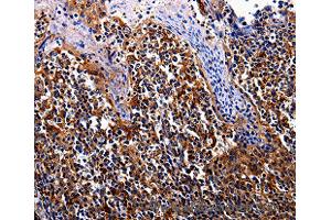 Immunohistochemistry of Human tosil  using IL17RC Polyclonal Antibody at dilution of 1:30 (IL17RC anticorps)