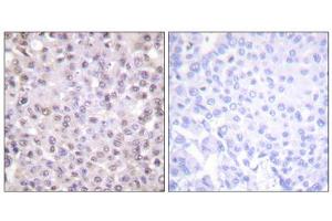 Immunohistochemistry analysis of paraffin-embedded human breast carcinoma, tissue using NCoR1 antibody. (NCOR1 anticorps  (N-Term))
