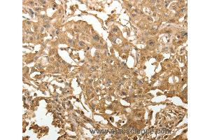 Immunohistochemistry of Human lung cancer using TXN Polyclonal Antibody at dilution of 1:40 (TXN anticorps)