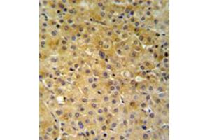 Immunohistochemistry analysis in formalin fixed and paraffin embedded hepatocarcinoma reacted with NDUFA10 Antibody (Center) followed which was followed by peroxidase conjugated to the secondary antibody and DAB staining. (NDUFA10 anticorps  (Middle Region))