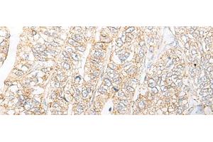 Immunohistochemistry of paraffin-embedded Human gastric cancer tissue using NME4 Polyclonal Antibody at dilution of 1:45(x200) (NME4 anticorps)