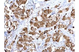 IHC-P Image Fatty Acid Synthase antibody [N1], N-term detects Fatty Acid Synthase protein at cytoplasm on human breast carcinoma by immunohistochemical analysis.