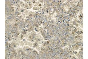 ABIN6265511 and ABIN6272444 at 1/100 staining human melanoma by IHC-P. (SERINC3 anticorps  (C-Term))