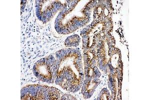 IHC-P: 17-beta-Hydroxysteroid dehydrogenase 4 antibody testing of human intestinal cancer tissue