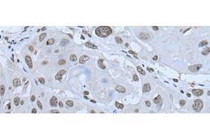 Immunohistochemistry of paraffin-embedded Human esophagus cancer tissue using HAND1 Polyclonal Antibody at dilution of 1:30(x200)