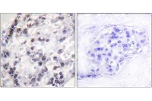 Immunohistochemistry analysis of paraffin-embedded human breast carcinoma tissue, using hnRNP C1/2 (Ab-260) Antibody. (HNRNPC anticorps  (AA 231-280))
