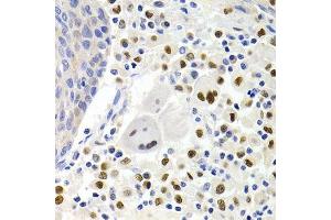 Immunohistochemistry of paraffin-embedded human lung cancer using GEMIN2 Antibody. (SIP1 anticorps)