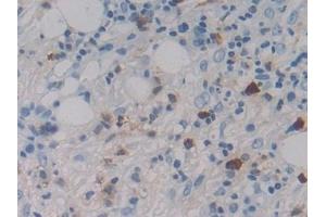 Detection of MASP1 in Human Skin cancer Tissue using Polyclonal Antibody to Mannose Associated Serine Protease 1 (MASP1)