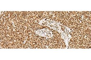 Immunohistochemistry of paraffin-embedded Human ovarian cancer tissue using GRSF1 Polyclonal Antibody at dilution of 1:30(x200) (GRSF1 anticorps)