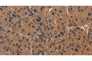 Immunohistochemistry of paraffin-embedded Human liver cancer using CD242 Polyclonal Antibody at dilution of 1:50 (ICAM4 anticorps)