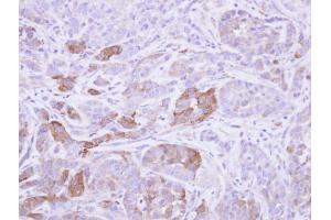 IHC-P Image Immunohistochemical analysis of paraffin-embedded A549 xenograft, using Villin , antibody at 1:500 dilution. (Villin 1 anticorps  (N-Term))