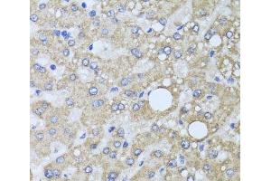 Immunohistochemistry of paraffin-embedded Human liver damage using AARS2 Polyclonal Antibody at dilution of 1:100 (40x lens).