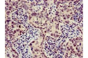 Immunohistochemistry of paraffin-embedded human pancreatic cancer using ABIN7175883 at dilution of 1:100 (XBP1 anticorps  (AA 1-167))