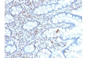 Formalin-fixed, paraffin-embedded human Colon Carcinoma stained with BMI1-Monospecific Mouse Monoclonal Antibody (BMI1/2689).