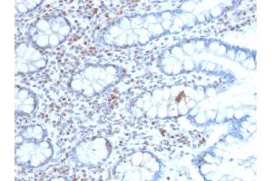 Formalin-fixed, paraffin-embedded human Colon Carcinoma stained with BMI1-Monospecific Mouse Monoclonal Antibody (BMI1/2689). (BMI1 anticorps  (AA 142-326))