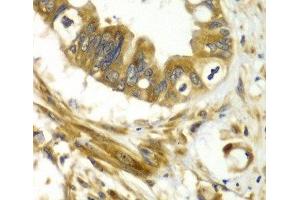 Immunohistochemistry of paraffin-embedded Human liver cancer using GBP1 Polyclonal Antibody at dilution of 1:100 (40x lens). (GBP1 anticorps)