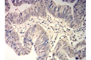 Immunohistochemical analysis of paraffin-embedded rectal cancer tissues using GSTP1 mouse mAb with DAB staining.