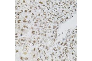 Immunohistochemistry of paraffin-embedded human lung cancer using FAF1 antibody. (FAF1 anticorps)