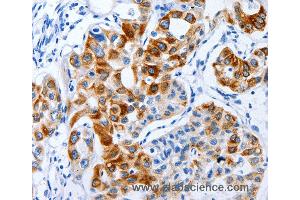 Immunohistochemistry of Human lung cancer using BPIFB3 Polyclonal Antibody at dilution of 1:120