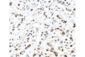 Immunohistochemistry of paraffin-embedded Human gastric cancer using HIRA Polyclonal Antibody at dilution of 1:100 (40x lens).
