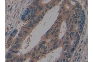 Detection of GLG1 in Human Colorectal cancer Tissue using Polyclonal Antibody to Golgi Glycoprotein 1 (GLG1)