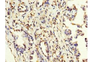 IHC image of ABIN7159260 diluted at 1:200 and staining in paraffin-embedded human lung cancer performed on a Leica BondTM system. (MAGEA3 anticorps  (AA 2-104))
