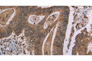 Immunohistochemistry of paraffin-embedded Human colon cancer tissue using MRGPRX1 Polyclonal Antibody at dilution 1:40 (MRGPRX1 anticorps)