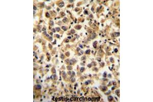 CCDC19 Antibody (N-term) immunohistochemistry analysis in formalin fixed and paraffin embedded human testis carcinoma followed by peroxidase conjugation of the secondary antibody and DAB staining. (CCDC19 anticorps  (N-Term))